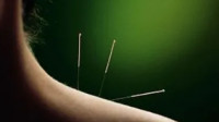Acupuncture